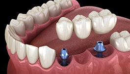 Diagram showing implant bridge replacing multiple missing teeth