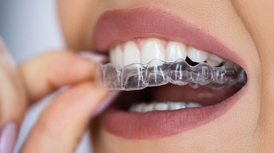 Woman removing upper arch of Invisalign with thumb and forefinger