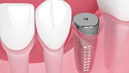 Digital illustration of a dental implant