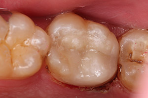 cerec 1 after