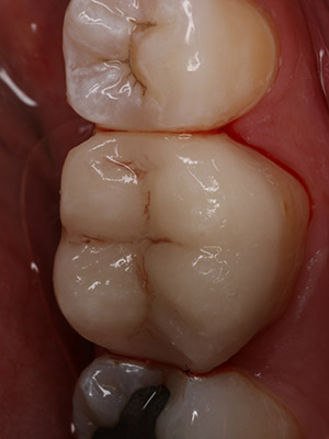 cerec 3 after