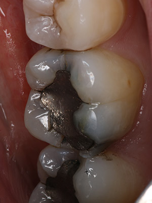 cerec 3 before