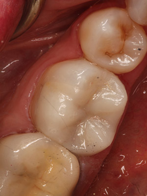 cerec 5 after