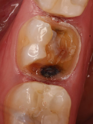 cerec 6 before