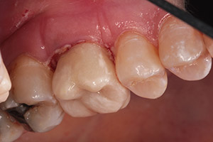 cerec 7 after