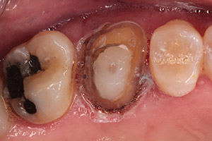 cerec 7 before