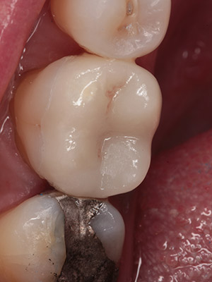 cerec 8 after