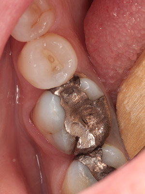 cerec 8 before