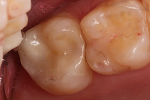 cerec 9 after