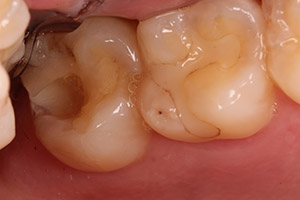 cerec 9 before