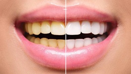 before and after teeth whitening