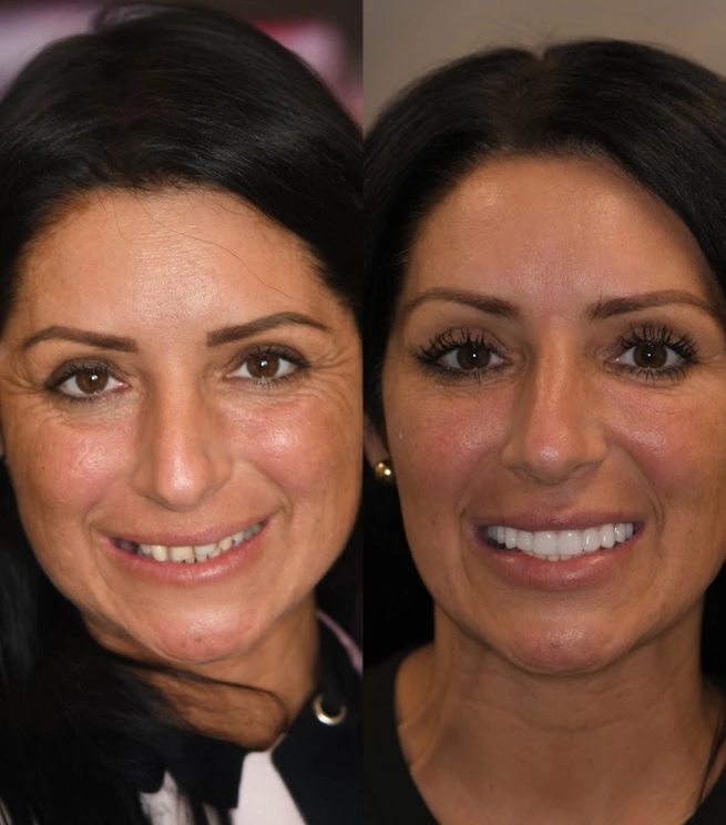 Brunette woman smiling before and after getting veneers