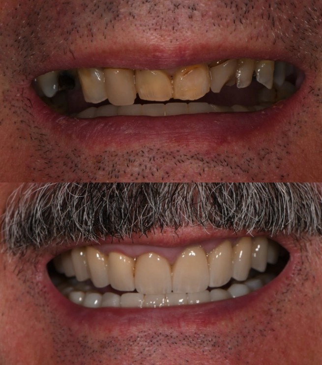 Close up of a man's smile before and after teeth whitening