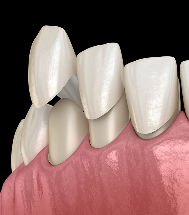 Illustration of veneers being placed over the teeth
