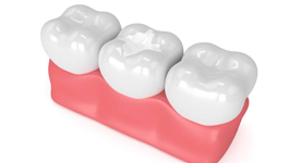 tooth-colored fillings