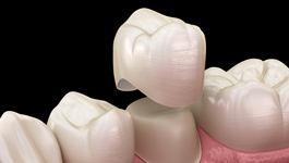 3D image of a crown being put on a tooth