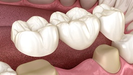 Digital image of a dental bridge 