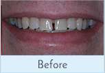 Close up of smile with gapped teeth before dental treatment