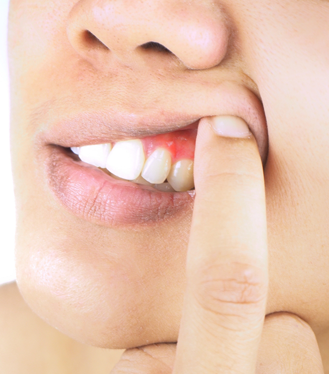 Person pointing to their red gums before gum disease treatment