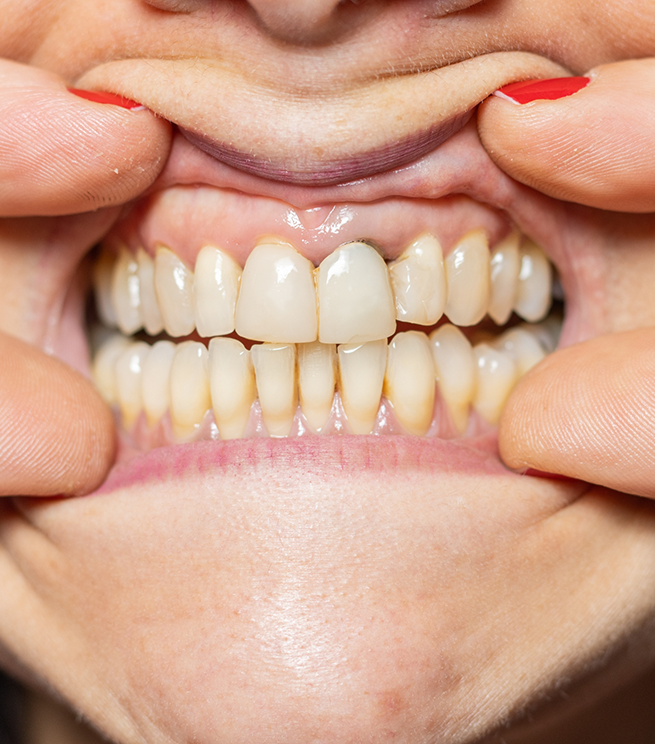 Close up of a mouth with yellowed teeth and receding gums