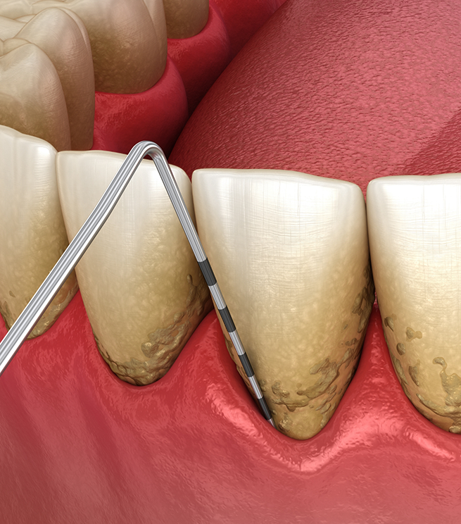 Illustration of gum disease treatment