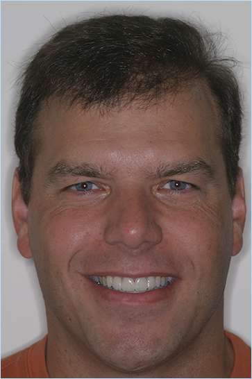 Man smiling with flawless teeth after treatment from Wakefield dentist