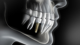 X-ray of a mouth with a dental implant