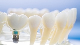 Model showing how dental implants work