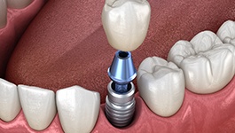 Diagram of a single tooth dental implant