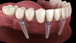 Diagram showing an implant denture