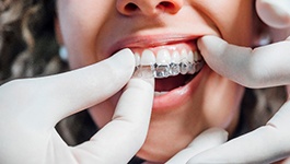 Dentist placing Invisalign aligners on top row of teeth