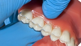 clear aligner on dental mold