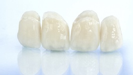 dental bridge & crowns