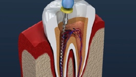 root canal therapy