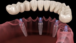 all-on-4 dental implants