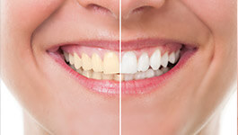 teeth whitening before and after