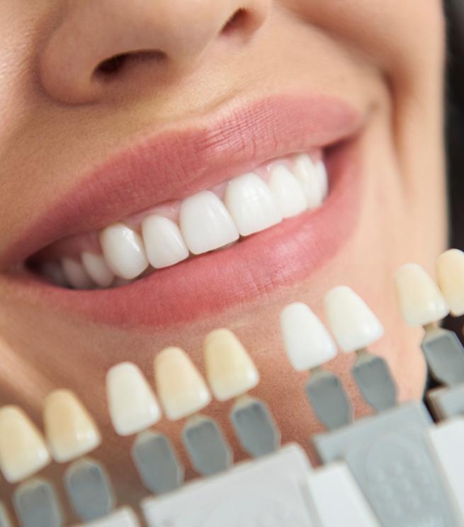 A woman using a tooth shade indicator