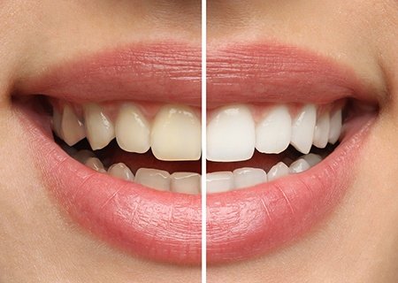 A woman before and after teeth whitening