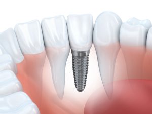 dental implant in lynnfield