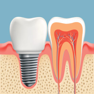 If you’re missing a tooth, don’t be embarrassed and let your oral health suffer! Work with Dr. Ron Schumacher and get the best dental implants in Lynnfield, MA. 