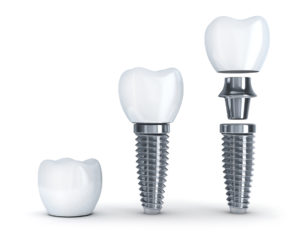 Have you thought of replacing your tooth with a dental implant in Lynnfield?