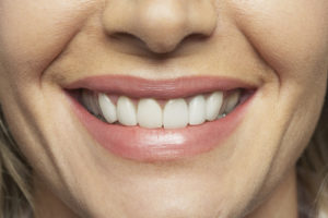 Porcelain veneers in Lynnfield are a wonderful cosmetic solution. 