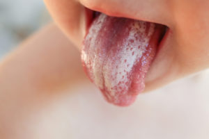 close-up of oral thrush