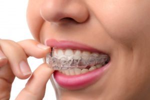 A person using clear aligners.