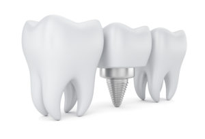 teeth and dental implant