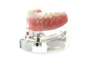 Denture being placed on implants