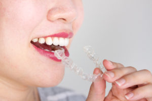 woman inserting invisalign aligners