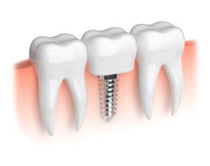 dental implant illustration