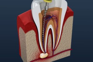 Root canal procedure on infected tooth