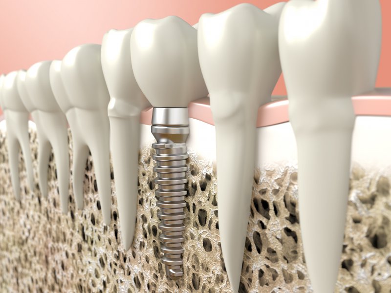 3D render of a dental implant